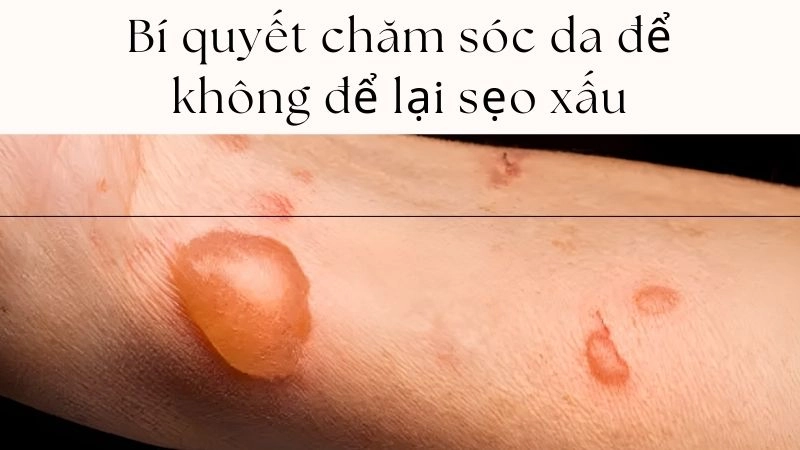 Bí quyết chăm sóc da để không để lại sẹo xấu