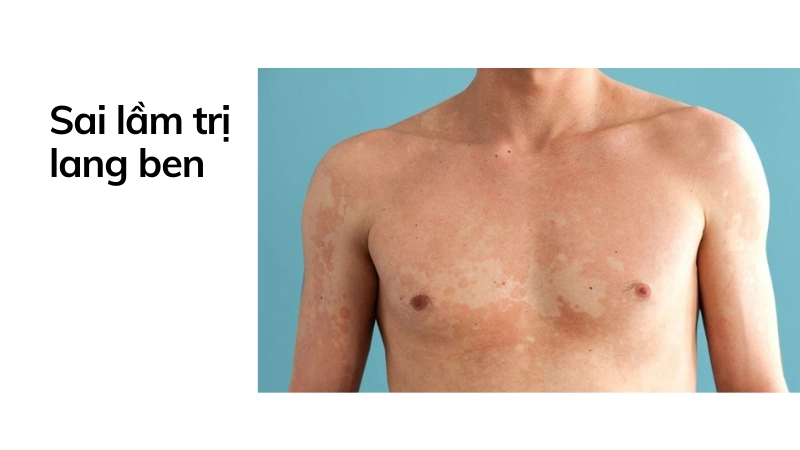 Sai lầm khi điều trị khiến bệnh lang ben lây lan