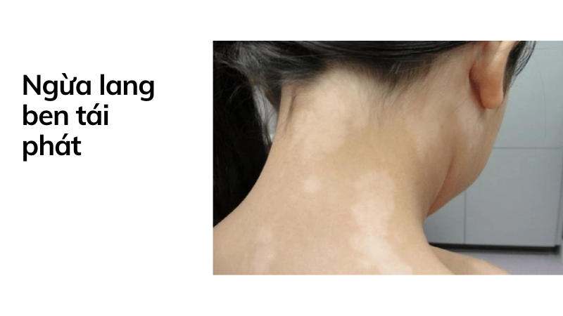 Cách ngăn ngừa lang ben tái phát mùa hè